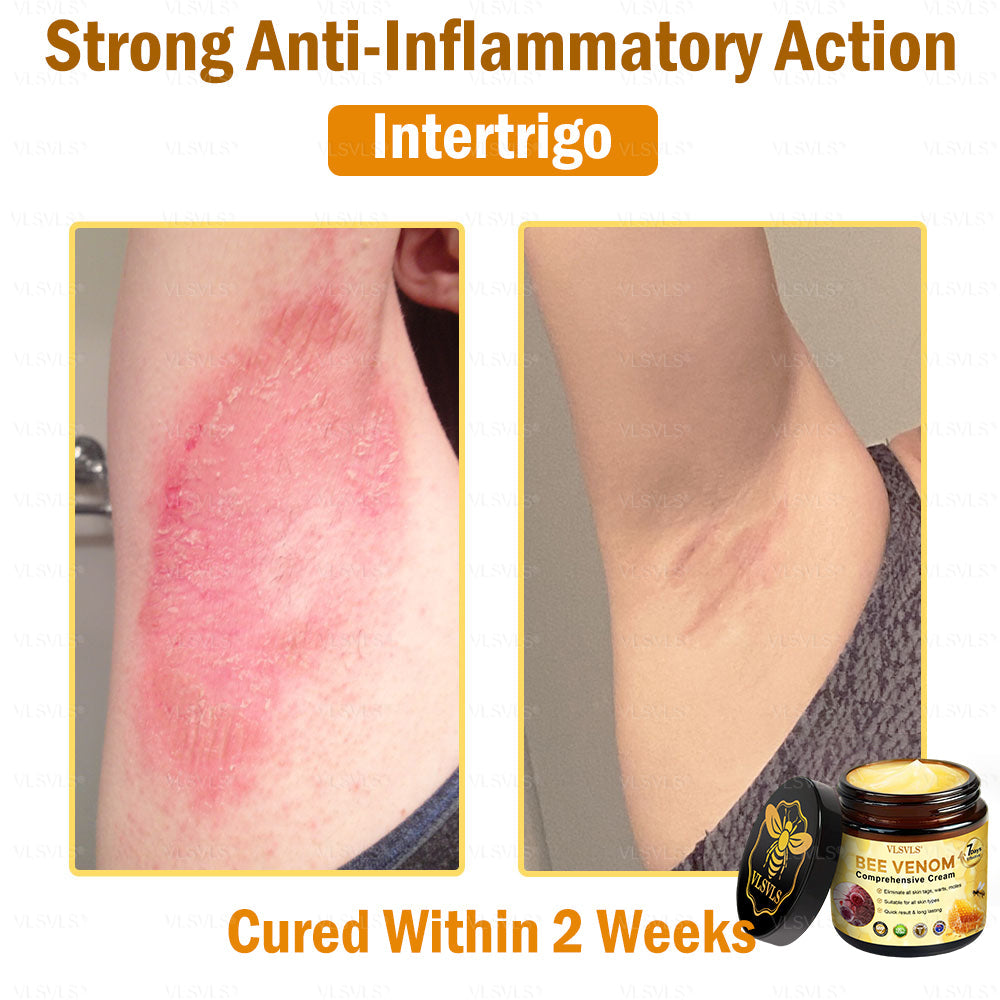 🧣🧣VLSVLS® Bee Venom Comprehensive Cream 🇭🇲🇭🇲(Suitable for all ages)